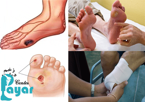 چرا آمپوتاسیون پای دیابتی ضروری و لازم است؟