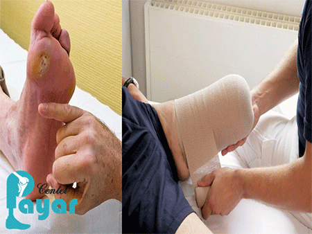 چرا کار به قطع پای دیابتی می رسد؟