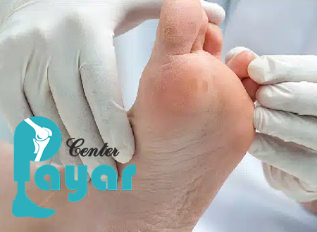 آشنایی با عوارض قطع انگشت پا