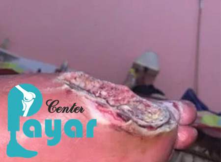 آمپوتاسیون پای دیابتی چیست