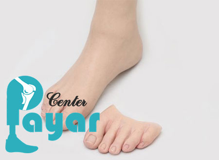 چگونه با نحوه جلوگیری از قطع پای دیابتی از ساخت پروتز انگشت پا پیشگیری کنیم؟