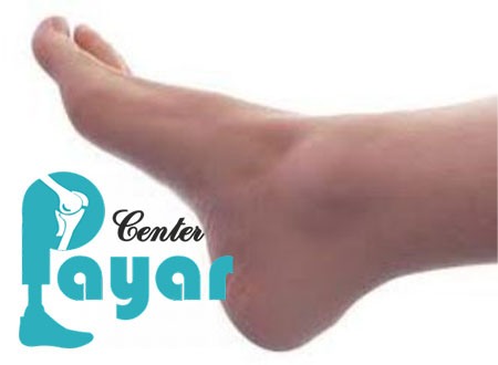قطع پا از مچ