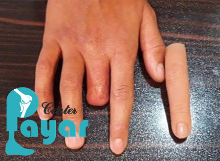 پروتز انگشت دست را چگونه نصب می کنند؟