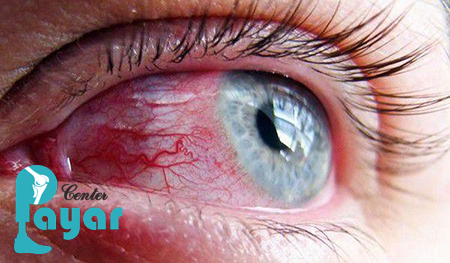 آیا بهتر نیست به جای درمان خانگی خونریزی چشم دیابتی، از بروز این عارضه پیشگیری کنیم؟