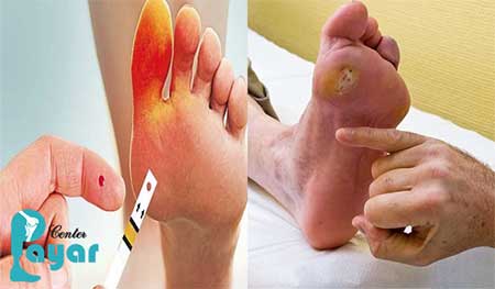 آیا در جریان هستید که چه زمانی پای دیابتی قطع می شود؟