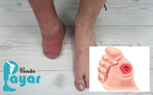 آیا در جریان هستید که چه زمانی پای دیابتی قطع می شود