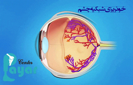 اهمیت درمان خانگی خونریزی چشم دیابتی
