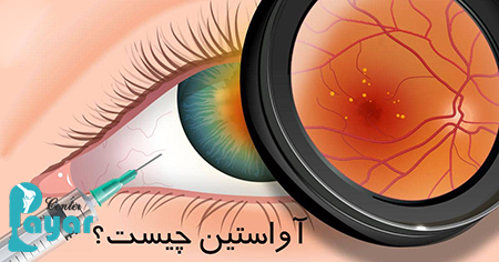 اگر درمان خانگی خونریزی چشم دیابتی جواب نداد، چه راه های دیگری برای درمان وجود دارد؟
