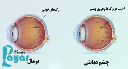 بهترین قطره برای درمان علائم خونریزی چشم دیابتی