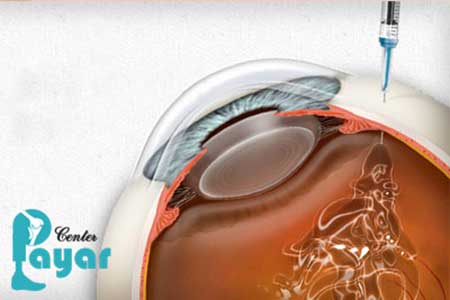 تزریق داخل چشمی برای کنترل علائم خونریزی چشم دیابتی