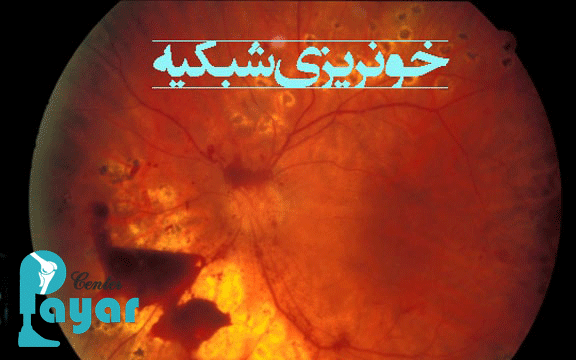 درمان خانگی خونریزی چشم دیابتی هر آنچه که باید بدانید