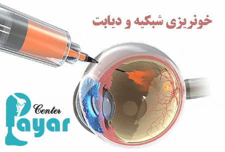 علائم خونریزی چشم دیابتی چیست؟ هر آنچه که باید بدانید