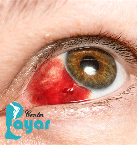 منع دارویی در درمان خانگی خونریزی چشم دیابتی؟