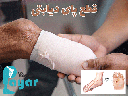 چه زمانی پای دیابتی قطع می شود؟ مراقب سلامت خود باشید