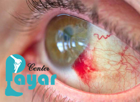 علائم خونریزی چشم دیابتی
