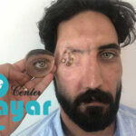 پروتز چشم اوربیتال چیست؟⭐هر آنچه که باید بدانید