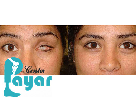 بهترین مرکز ساخت پروتز چشم در مشهد