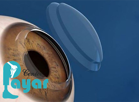 با انواع ایمپلنت ساخت پروتز چشم آشنا شوید؟