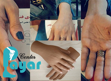 با مراحل ساخت پروتز مچ دست آشنا شوید