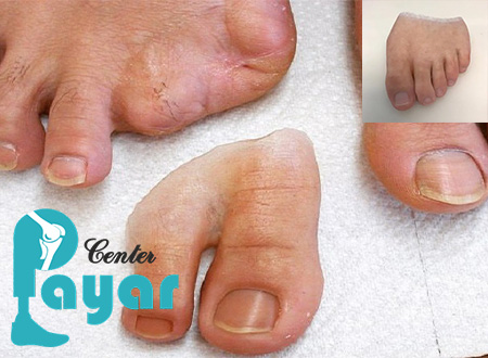 قیمت ساخت پروتز انگشت پا در چه کسانی رو به افزایش است؟