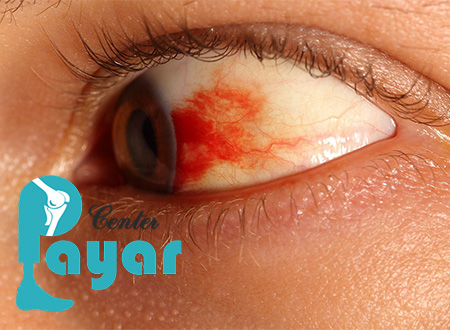 علائم خونریزی چشم دیابتی چیست