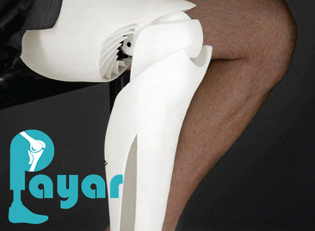 از معایب و مشکلات ساخت پروتز پا بالای زانو چه می دانید؟