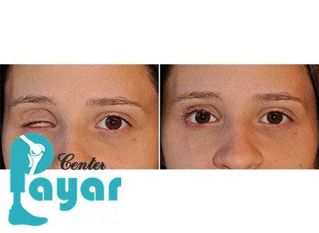 بهترین مرکز ساخت پروتز چشم در مشهد را انتخاب کنیم یا به مراکز تهران برویم؟