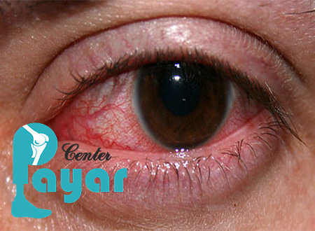 علائم خونریزی چشم دیابتی و درمان خونریزی چشم دیابتی چگونه است؟