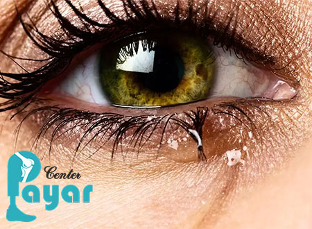 علت آبریزش چشم در طب سنتی