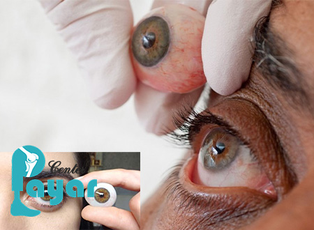 برای ساخت پروتز چشم مصنوعی کلنیک پایار چه کنیم؟