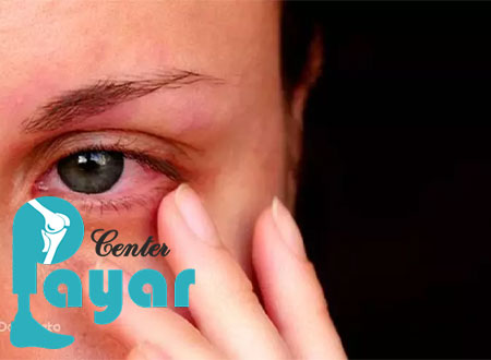 علت آبریزش چشم در بزرگسالان چیست؟