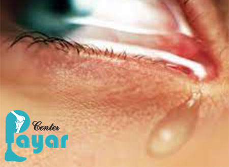 علت آبریزش چشم در طب سنتی و طب اسلامی