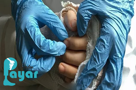 پیوند دست قطع شده از مچ چگونه انجام می شود؟