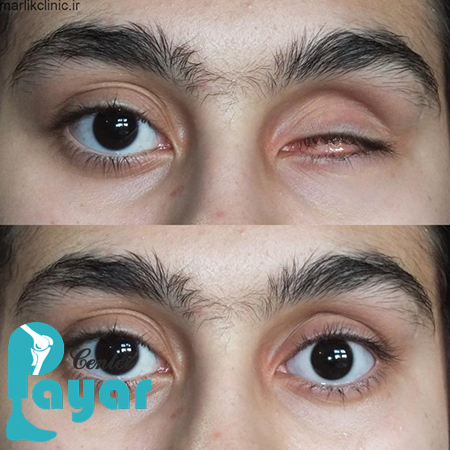 بهترین مرکز ساخت پروتز چشم در شیراز