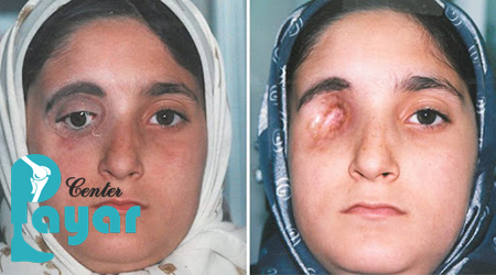 بیماری های خطرناک باعث ساخت پروتز چشم می شوند