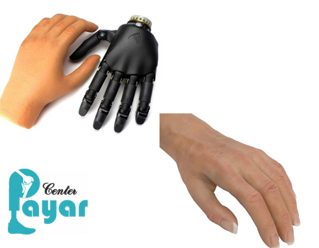 ساخت پروتز مچ دست،بهترین جایگزین برای دست قطع شده