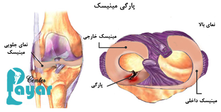 ایا پارگی مینیسک زانو ترمیم میشود؟ در این خصوص چه می دانید؟