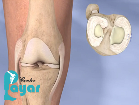 ایا پارگی مینیسک زانو ترمیم میشود؟ در این مورد چه میدانید؟