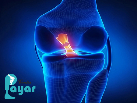 در مورد علائم پارگی رباط صلیبی چه میدانید؟