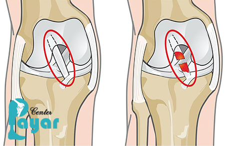 علائم پارگی رباط صلیبی چیست؟