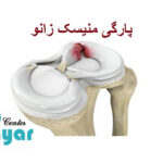 ایا پارگی مینیسک زانو ترمیم میشود؟ [جامع و کاربردی]