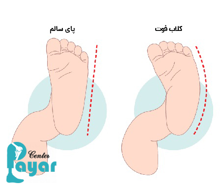 بهترین راه برای جلوگیری و پیشگیری از پا چنبری چیست؟