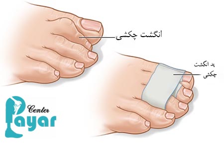 بهترین روش درمان انگشت چکشی پا چیست