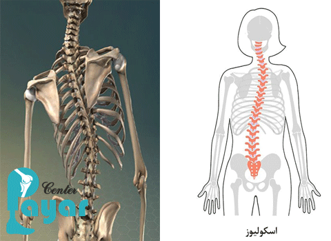 تعیین درجه اسکولیوز چیست؟در مورد آن چه میدانید