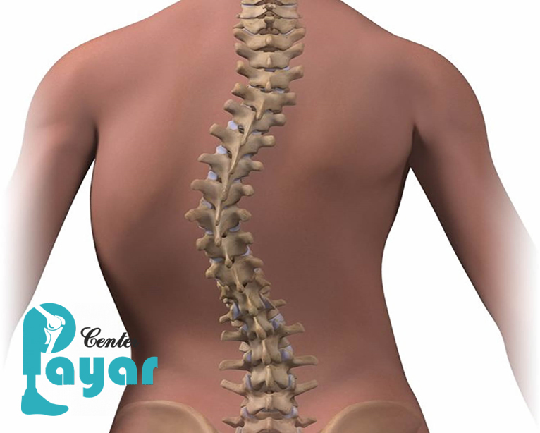 در مورد اینکه آیا بیماری اسکولیوز خطرناک است چه میدانید؟