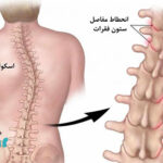 انواع اسکولیوز چیست؟ بررسی علت و درمان اسکولیوز