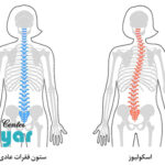 علت اسکولیوز چیست؟ راه درمان آن