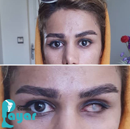 ساخت پروتز چشم مصنوعی با قابلیت دید واقعی