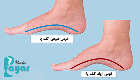 ساخت کفش و کفی طبی برای پای قوس دار