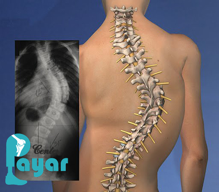 آشنایی کامل با آیا اسکولیوز باعث فلج شدن میشود